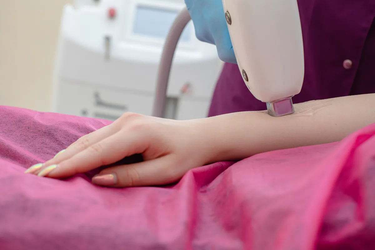 Epilare cu laser