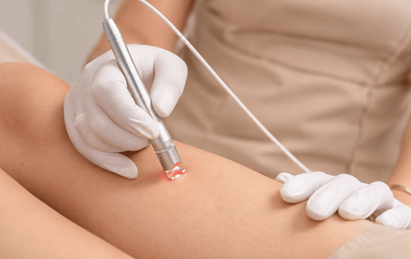 Îndepărtarea cu laser a rețelelor vasculare