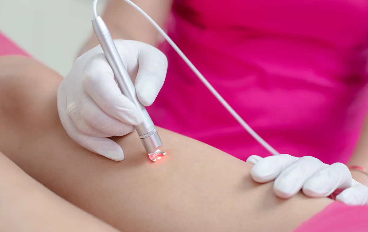 Inlaturarea capilarelor cu laser
