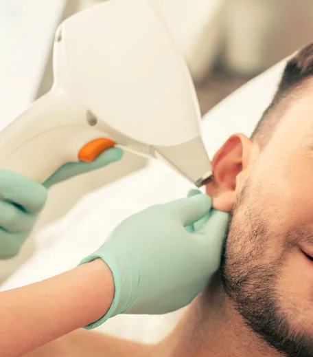 Epilare cu laser pentru barbati