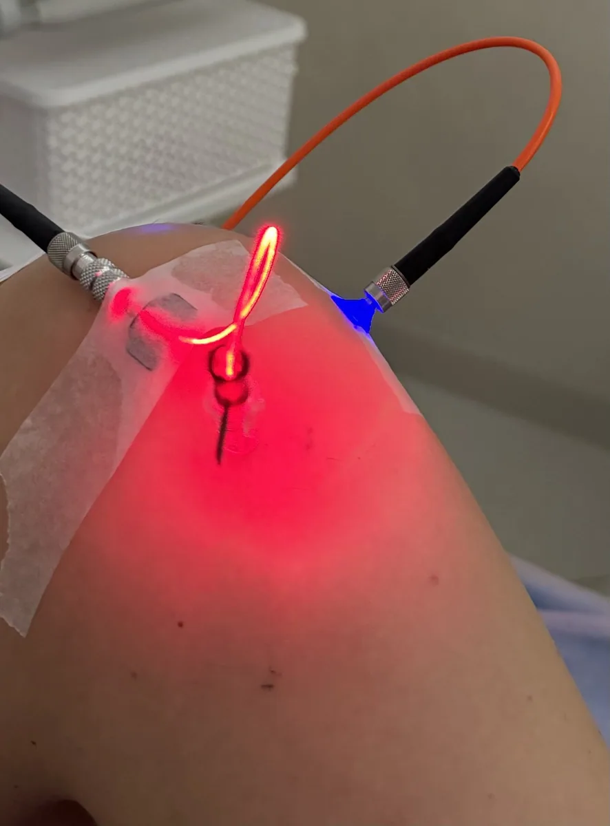 Laser Weber intraarticular
