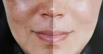 grid-pete-pigmentare-dermabeautyjpg-2-21757003921.jpg